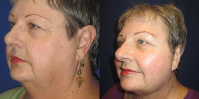Facelift before and after photo