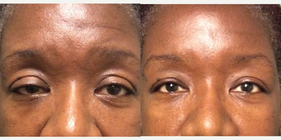 Ptosis Surgery before and after photo