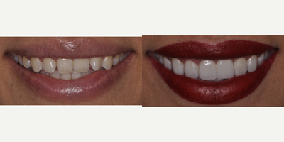 Smile Makeover before and after photo