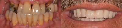 All-on-4 Dental Implants before and after photo