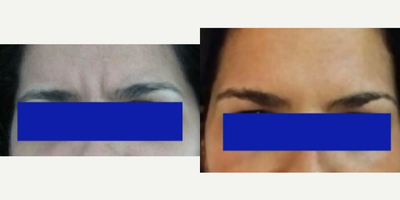 Botox before and after photo