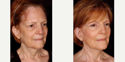 Facelift before and after photo