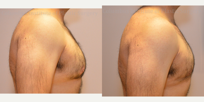 Gynecomastia Surgery before and after photo