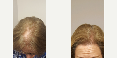 Hair Transplant before and after photo