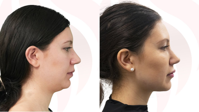 Kybella before and after photo