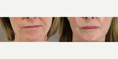 Laser Resurfacing before and after photo