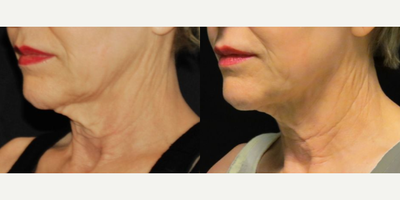 Venus Legacy before and after photo