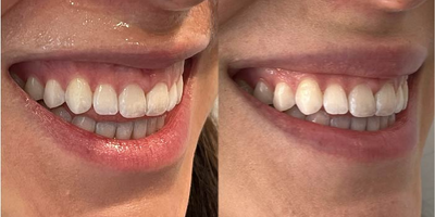Botox before and after photo