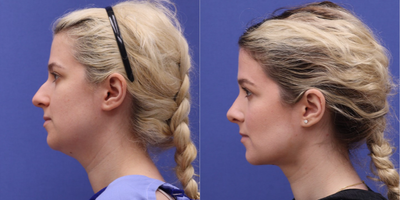 Buccal Fat Removal before and after photo