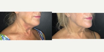CoolSculpting before and after photo