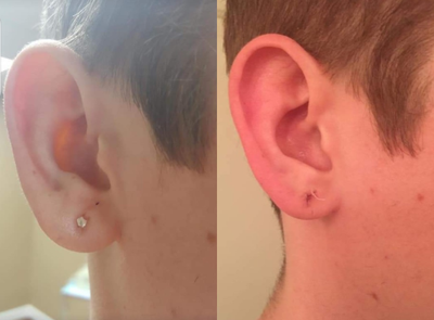 Dermal Fillers before and after photo