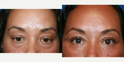 Eyelid Surgery before and after photo