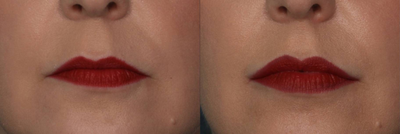 Juvederm before and after photo