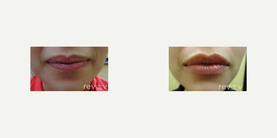 Juvederm before and after photo