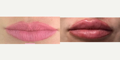 Lip Fillers before and after photo