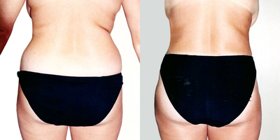 Liposuction before and after photo