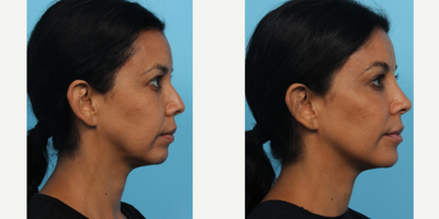 Restylane before and after photo