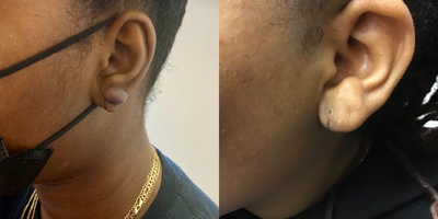 Scar Removal before and after photo