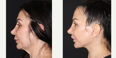 Buccal Fat Removal before and after photo