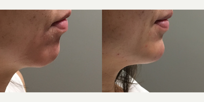 Chin Filler before and after photo
