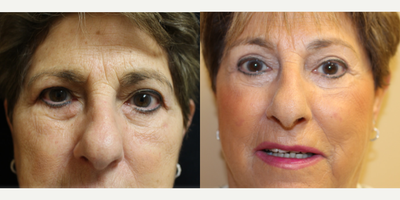 Eyelid Surgery before and after photo