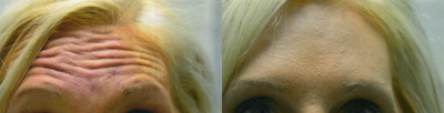 Botox before and after photo