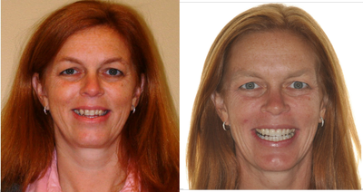 Braces before and after photo