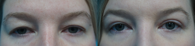 Eyelid Surgery before and after photo