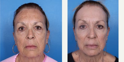 Laser Resurfacing before and after photo