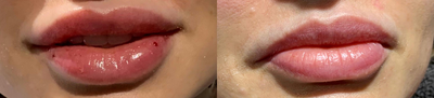 Lip Fillers before and after photo