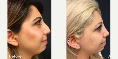 Rhinoplasty before and after photo