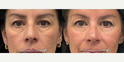 Rhinoplasty before and after photo
