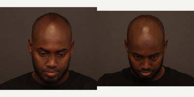 African American Rhinoplasty before and after photo