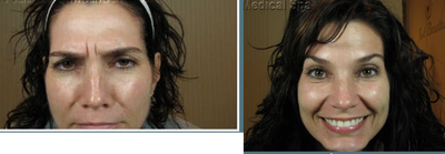 Botox before and after photo