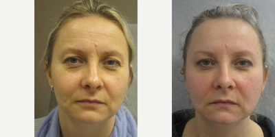 Botox before and after photo
