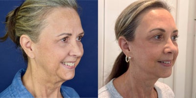 Brow Lift before and after photo