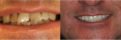 Dental Crown before and after photo