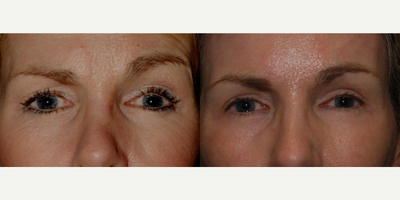 Eyelid Surgery before and after photo
