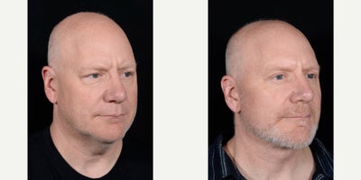 Eyelid Surgery before and after photo