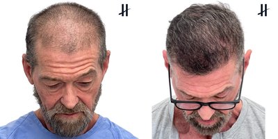 FUE Hair Transplant before and after photo