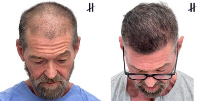 FUE Hair Transplant before and after photo