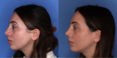 Revision Rhinoplasty before and after photo