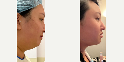Buccal Fat Removal before and after photo