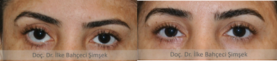 Eyelid Retraction Repair before and after photo