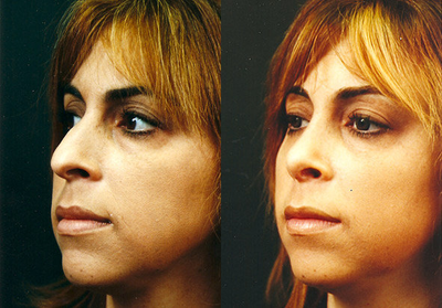 Rhinoplasty before and after photo
