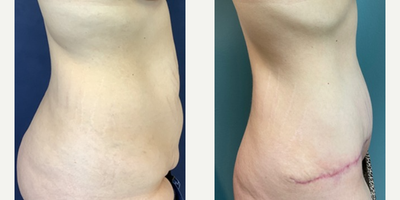 Tummy Tuck before and after photo