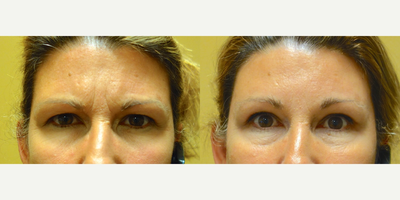 Brow Lift before and after photo
