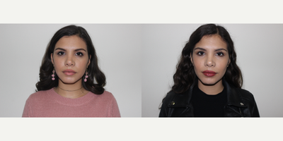 Buccal Fat Removal before and after photo