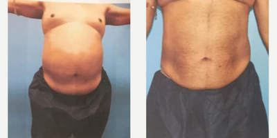 CoolSculpting before and after photo