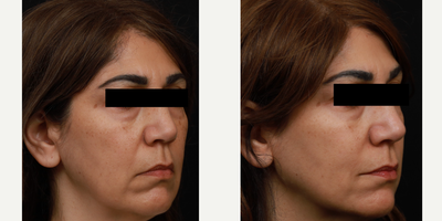 Dermal Fillers before and after photo
